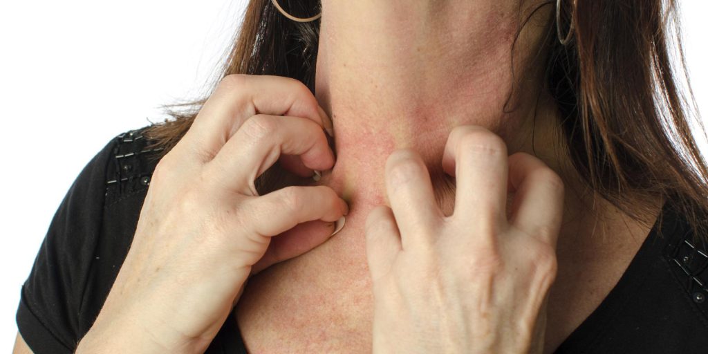 Alergia por Estrés